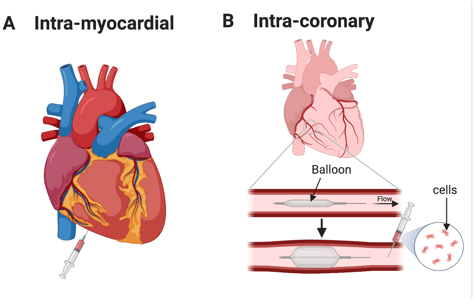 Hypoplastic left heart syndrome (HLHS): molecular pathogenesis and ...