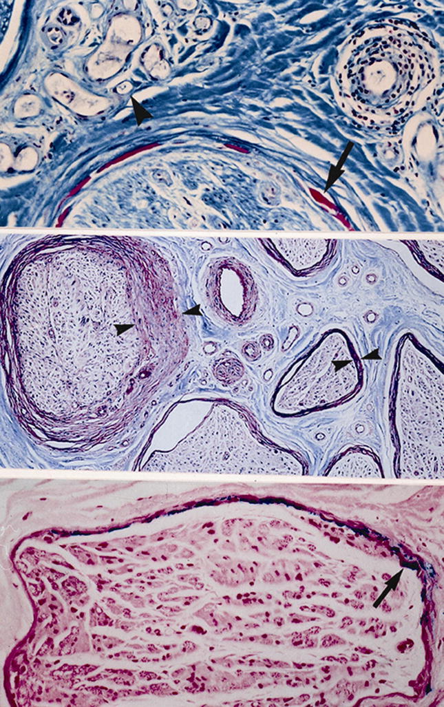 The Spectrum of Diabetic Neuropathies - PMC