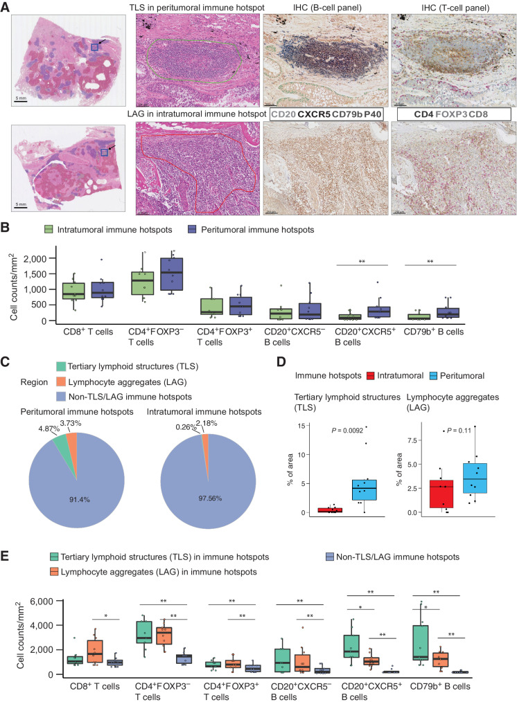 Figure 4. Lymphocyte composition and the presence of TLS at intratumoral and peritumoral IH. A, Example regions showing annotations of TLS at the IH, and pathologically defined lymphoid aggregates without a prominent germinal center (LAG) at the intratumoral IH. B, Lymphocyte subset densities at intratumoral and peritumoral IH. Cell densities were measured as the cell counts divided by the total area of immune hotspots. C, Pie chart displaying the average percentages of peritumoral IH and intratumoral IH identified as TLS, LAG and non-TLS/LAG IH. D, Densities of TLS and LAG at intratumoral and peritumoral IH. E, Densities of B- and T-cell subsets in TLS, LAG and non-TLS/LAG IH. Statistical significance was evaluated by the Wilcoxon signed-rank test followed by the Benjamini–Hochberg method for P value adjustment. *, P < 0.05; **, P < 0.01. The median was marked by the horizontal line; the first and third quartiles were shown as box edges; whiskers indicate the range of error.