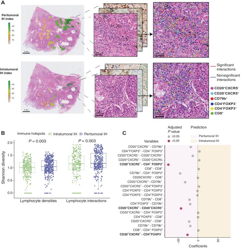 Figure 5. Diversity of lymphocyte interactions in intratumoral and peritumoral IH without TLS or LAG. A, Examples of lymphocyte interactions in individual peritumoral and intratumoral IH. Lymphocytes identified on the serial IHC slides were connected by the Delaunay triangle graph. Lymphocyte subsets were represented by dots of different colors. Interactions significant in the univariate logistic regression were denoted by red, otherwise blue. B, Shannon diversity of lymphocyte interactions in individual peritumoral and intratumoral IH. C, Univariate logistic regression predicting peritumoral and intratumoral IH with individual lymphocyte interactions as variables. The coefficients of the significant variables were all negative, suggesting a higher frequency of the interactions in peritumoral IH compared with intratumoral IH. P values were adjusted by the Benjamini–Hochberg method. Regions identified as TLS or LAG were excluded from the above analyses.