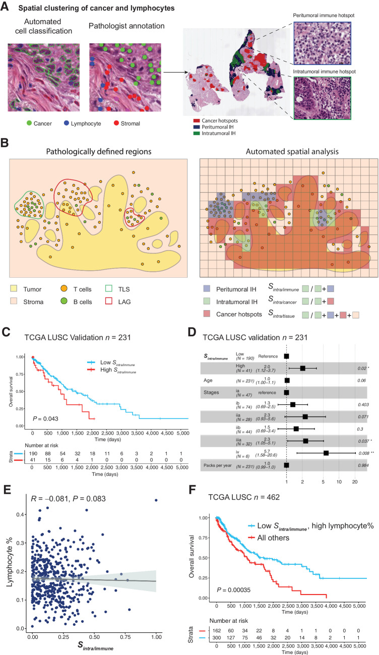 Figure 1. Immune hotspots in LUSC. A, Illustrative examples of automatic cell classification results and hotspot distribution with zoomed-in regions showing areas enriched with immune cells and cancer–immune coclustering. Cancer hotspots (red) and immune hotspots were identified based on the local clustering of cancer and lymphocytes. Intratumoral IH (green) was determined as regions enriched with both immune and cancer cells, while peritumoral IH were regions enriched with only immune cells. B, Schematic representations of tissue compartments including cancer hotspots, peritumoral IH, and intratumoral IH based on automated spatial analysis; and pathologically defined tertiary lymphoid structures (TLS) and lymphoid aggregates without clear separation of T- and B-cell zones (LAG). The three spatial scores Sintra/immune, Sintra/cancer, and Sintra/tissue were determined as the proportion of intratumoral IH in the immune-rich area (intratumoral IH and peritumoral IH), cancer-rich area (intratumoral IH and cancer hotspots), and the entire tissue respectively. C, Kaplan–Meier curves to illustrate the difference in OS in LUSC patients stratified by Sintra/immune, with the dichotomization optimized for the discovery cohort (n = 231) and assessed in the validation cohort (n = 231). D, Forest plots to show the prognostic value of Sintra/immune in multivariate models adjusted for stage, age, and smoking pack years in the validation cohort. E, Scatter plot to show the lack of correlation between lymphocyte percentage and Sintra/immune in the entire TCGA cohort. F, Kaplan–Meier curve to illustrate the difference in OS in LUSC patients stratified by both Sintra/immune and lymphocyte percentage, with the stratification of the entire cohort shown (n = 462).