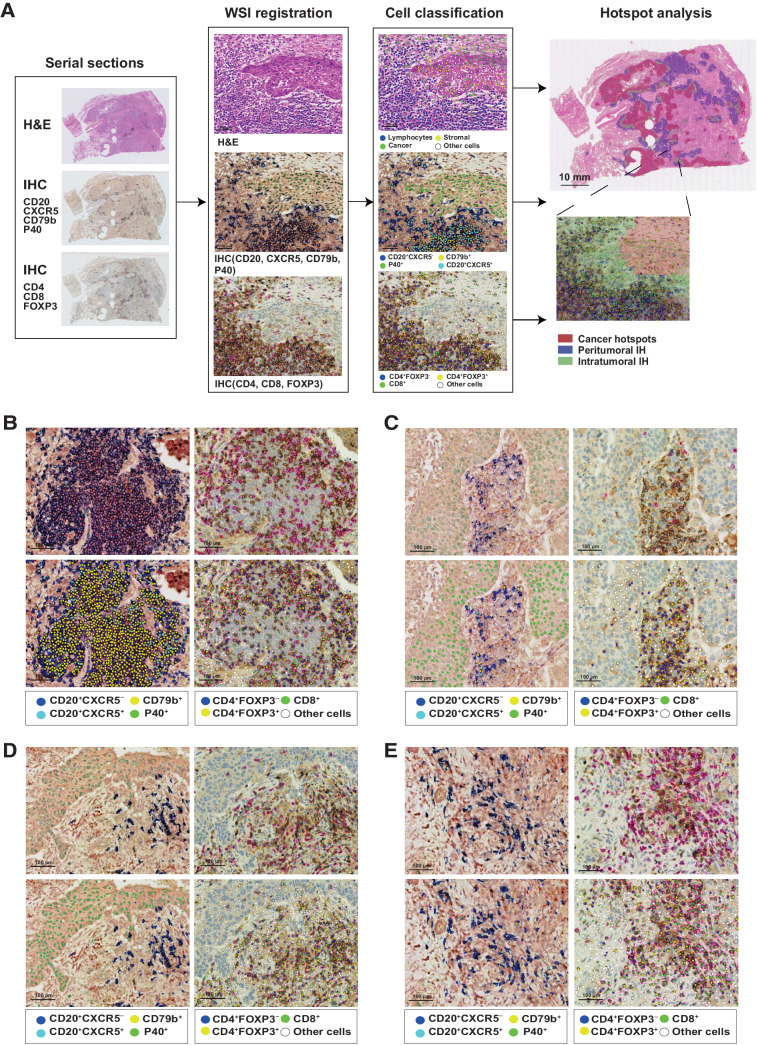 Figure 3. The deep learning pipeline to map T-cell and B-cell subtypes at intratumoral and peritumoral IH. A, Framework of the deep learning pipeline for spatial analysis. The pipeline comprised 3 steps: serial section alignment, deep-learning-based cell classification, and hotspots mapping. IHC staining with B-cell panel (CD20/CXCR5/CD79b/P40) and T-cell panel (CD4/FOXP3/CD8) was performed on serial sections, which were then aligned to the corresponding H&E section. Dominant B-cell subsets (CD20+CXCR5−, CD20+CXCR5+, CD79b+) and T-cell subtypes (CD4+FOXP3−, CD4+FOXP3+, CD8+) were detected and classified by deep learning models and projected to the H&E slide. The results were illustrated as a magnified region with cells detected on two registered IHC sections and hotspots identified on the corresponding H&E slide. B–E, Representative TLS, LAG, non-TLS/LAG intratumoral IH, non-TLS/LAG peritumoral IH. Cell classification results were shown below the original image, with color codes for each cell type shown at the bottom. Scale bar, 100 μm.