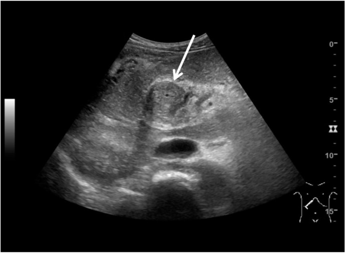 Mass Forming Portal Biliopathy Presenting As Extreme Wall Thickening Of The Common Bile Duct Pmc