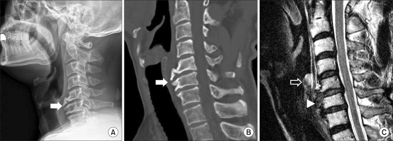 Anterior Cervical Osteophytes Causing Dysphagia and Paradoxical Vocal ...