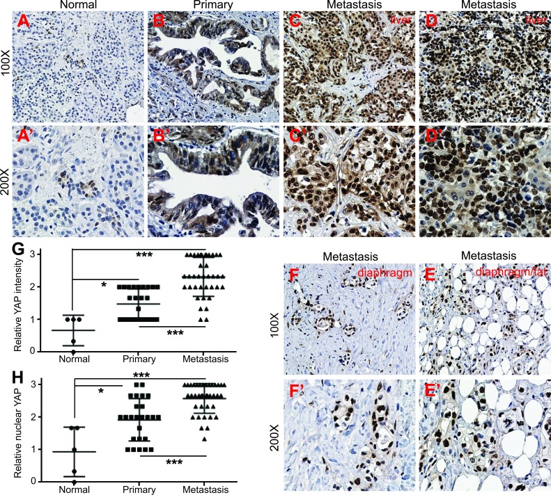 Active YAP promotes pancreatic cancer cell motility, invasion and ...