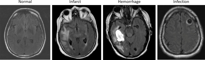 Examples of axial fluid-attenuated inversion recovery sequence acquisitions from studies within dataset A. From left to right: a patient with “likely normal” brain findings, a patient presenting with an intraparenchymal hemorrhage within the right temporal lobe, a patient presenting with an acute infarct of the inferior division of the right middle cerebral artery, and a patient with known neurocysticercosis presenting with a rounded cystic lesion in the left middle frontal gyrus.