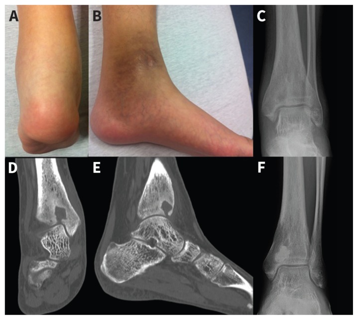 Brodie abscess - PMC