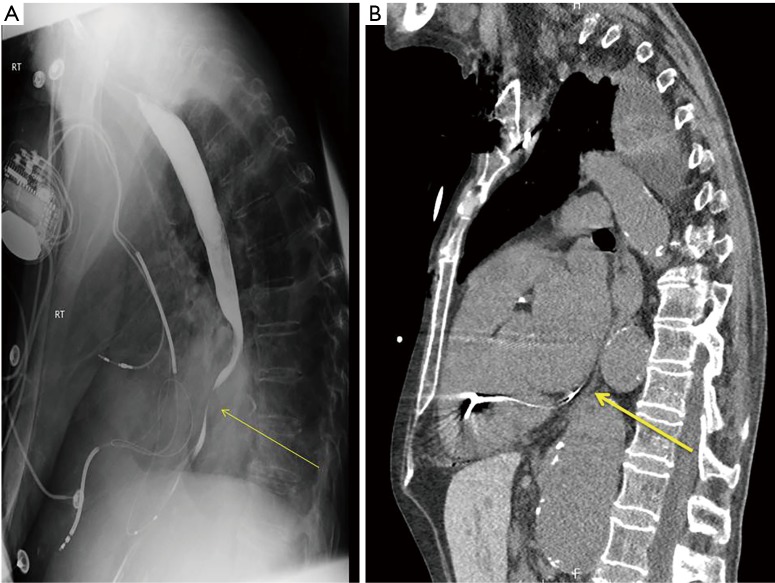 Dysphagia in the aging cardiovascular patient - PMC