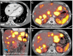 A 45-year-old male patient with carcinoid heart disease. (A) Cardiac CT image
shows enlargement of the right atrium (*) and ventricle (o). (B) Coronal
tetraazacyclododecane tetraacetic acid–octreotate (DOTATATE) PET/CT image
shows the primary small bowel lesion (blue arrow) and multiple liver metastases
(white arrow) with high somatostatin receptor expression. When compared with
baseline study (C), there is mildly decreased but persistent high somatostatin
receptor expression in the majority of the liver metastases after four cycles of
lutetium 177-DOTATATE (Lutathera; Novartis) (D).