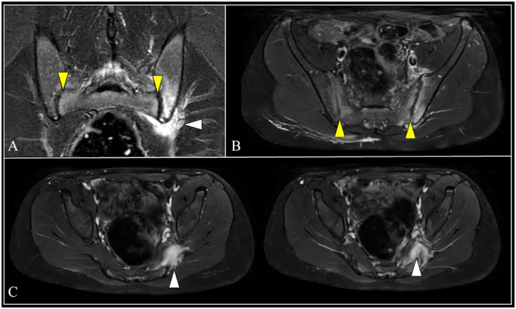 Ultrasound imaging for sternoclavicular joint involvement in enthesitis ...