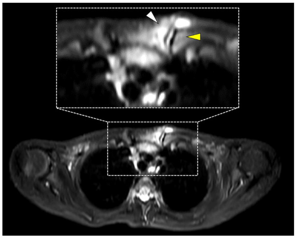 Ultrasound imaging for sternoclavicular joint involvement in enthesitis ...