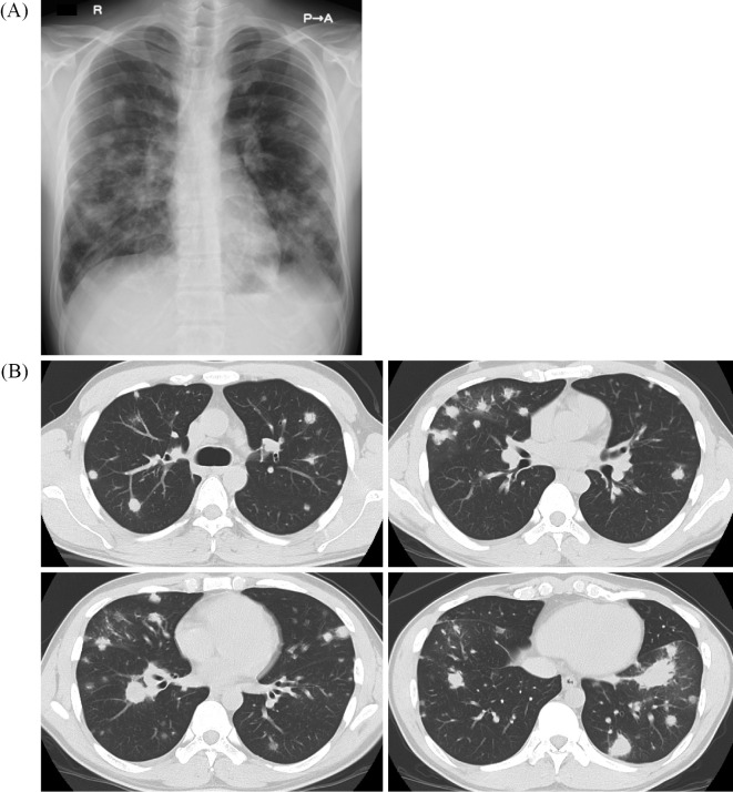 Necrotizing Sarcoid Granulomatosis with Natural Resolution after a ...