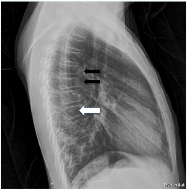 FIGURE 2. Chest radiograph of patient, lateral view. Note the multiple compression fractures of the caudal thoracic vertebral bodies (black arrows) and demineralization throughout the thoracic vertebrae (white arrow).