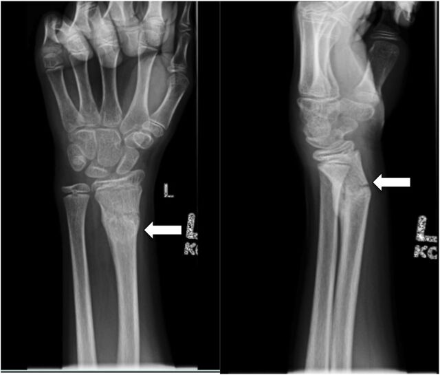 FIGURE 1. Wrist radiograph, anteroposterior and lateral views. Note the transverse fracture through the distal left radial diaphysis with callus formation (white arrow).