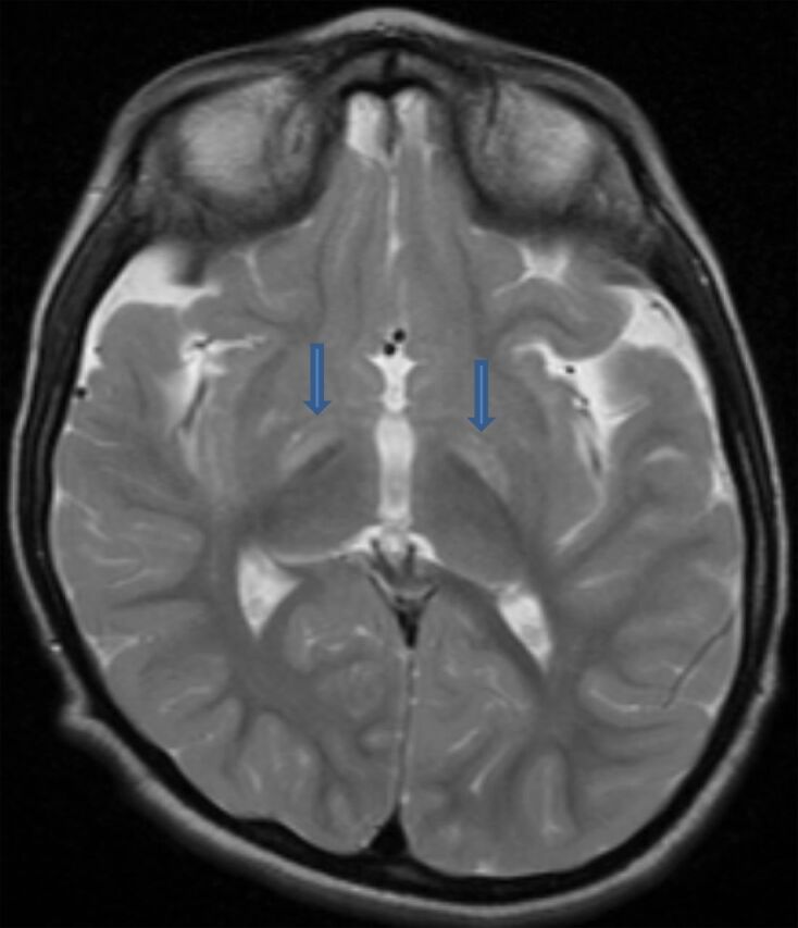 Figure 1. Basal ganglia deposition of bilirubin (arrows) as revealed by brain magnetic resonance imaging.