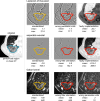 Three filters are used to quantify different characteristics of the
peritumoral region in a chest CT, with an out-of-plane tumor. For each filter,
mean and maximum intensity are computed within the segmentation masks in three
filtered images. The standardized filtered image was created by applying a
standardized filter to the original image. The other two filtered images
resulted from filter implementations that were not standardized. The Laplacian
of Gaussian filter is used to quantify the presence of edges and highlight fine
details. The scale of the filter is 2.0 mm, and it is truncated at 8.0 mm. The
nonstandardized filters use 2.0 voxels and truncate at one filter scale (2.0
mm). Separable wavelets are designed to quantify image contents for different
frequency bands, though in many radiomics analyses they are used to quantify
edges. A pair of low-pass and high-pass wavelet kernels is used to filter the
image, highlighting edges in the lateral direction. The nonstandardized filters
either use an incorrect orientation (ie, low-pass and high-pass kernels were
swapped) or are faulty because the first kernel is used for all directions (ie,
a pair of low-pass-low-pass wavelet kernels). Gabor filters are used to quantify
directional structures (eg, fibrosis and bronchi). The standardized filter used
scale and wavelength parameters of 2.0 mm and was oriented under 30°. The
nonstandardized filters use an incorrect orientation or express parameters in
2.0 voxels.