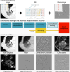 Overview of convolutional filters. An image is filtered using convolution
to create a filtered image (top). Each image consists of values. At convolution,
a filter with three weights (1.0, −2.0, 1.0) is slid across the image,
and adjacent image values are multiplied with the corresponding filter values
and summed to create a response value for each position in the image.
Convolutional filtering is positioned after resampling in the overall radiomics
image processing scheme (center). This workflow starts with an image obtained
from a repository or archiving system in a digital format. The image is
optionally converted (eg, from PET activity to standardized uptake values) and
undergoes postprocessing (eg, MRI bias-field correction). Segmentation masks are
either loaded in a digital format or automatically created. Both image and
segmentation masks are optionally resampled. Filtered images are created by
filtering the image. Filtered images and segmentation masks are then used to
compute radiomic features. This study attempts to standardize several types of
convolution filters (bottom). The original CT image is shown for
reference.