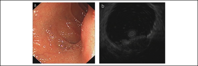 Diagnosis And Treatment Of Duodenal Gastrointestinal Stromal Tumors Pmc