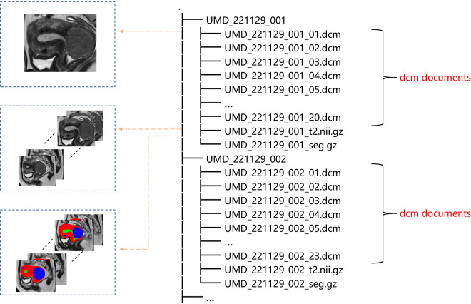 Large-scale uterine myoma MRI dataset covering all FIGO types with ...