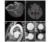 Fig.2. A representative case with thoracic aortic plaque burden score (T3) and obstructive coronary artery disease leading to stroke