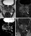 Images in a 59-year-old man with a prostate-specific antigen level of 2.9
ng/mL and a prior negative prostate biopsy. (A) Axial T2-weighted MRI scan shows
a subtle, noncircumscribed, moderately hypointense focus in the left base
posteromedial peripheral zone (arrow) (T2-weighted MRI Prostate Imaging
Reporting and Data System [PI-RADS] score of 3). On the (B) axial
diffusion-weighted image with a high b value (1400 sec/mm2), the lesion has
ill-defined mildly hyperintense signal (arrow), and on the (C) apparent
diffusion coefficient (ADC) map, it has markedly hypointense signal (arrow)
(diffusion-weighted imaging and ADC PI-RADS score of 3). On the (D) dynamic
contrast-enhanced (DCE) MRI scan, the lesion shows early contrast enhancement
(arrow) (DCE MRI PI-RADS score of positive). The final assessment category
assigned was PI-RADS category 4. The focal abnormality was not identified at the
time of the MRI interpretation by a novice reader, who assigned PI-RADS category
2 to the examination. Upon review of the images by a more experienced reader,
the lesion was identified, and an MRI-targeted biopsy of the lesion revealed
prostate cancer with a Gleason score of 3+4.
