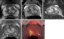 Images in a 74-year-old man with a serum prostate-specific antigen level
of 12.9 ng/mL. (A) Axial T2-weighted MRI scan, (B) apparent diffusion
coefficient map, and (C) diffusion-weighted image with a b value of 1500 sec/mm2
demonstrate no focal lesion within the prostate gland. (D) Dynamic
contrast-enhanced MRI scan shows a very subtle linear enhancement in the right
mid peripheral zone (arrow). Overall, the multiparametric MRI examination was
negative for a cancer-suspicious lesion according to the Prostate Imaging
Reporting and Data System. (E) Axial fluorine 18 DCFPyL PET/CT image
demonstrates bilateral uptake (greater on the right side) in the prostate
(arrows). Prostate biopsy revealed Gleason 4+3 prostate cancer within the right
mid peripheral zone. DCFPyL =
2-(3-{1-carboxy-5-[(6-18F-fluoro-pyridine-3-carbonyl)-amino]-pentyl}-ureido)-pentanedioic
acid).