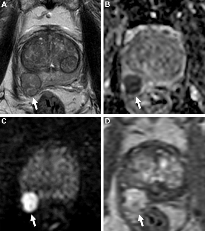 Images in a 78-year-old man with a serum prostate-specific antigen level of 10 ng/mL. (A) Axial T2-weighted MRI scan shows a well-encapsulated nodule in the right mid peripheral zone (arrow), which suggests an ectopic benign prostatic hyperplasia nodule. (B) The apparent diffusion coefficient map and (C) diffusion-weighted image with a b value of 1500 sec/mm2 show the nodule with diffusion restriction with prominent hypointense and hyperintense signal features (arrows), and the (D) dynamic contrast-enhanced (DCE) MRI scan shows focal early enhancement (arrow). The T2-weighted imaging, diffusion-weighted imaging, DCE MRI, and overall Prostate Imaging Reporting and Data System scores of this lesion were 2, 5, positive, and 5, respectively. Transrectal US/MRI–fusion guided biopsy revealed Gleason 4+4 prostate cancer within this lesion.