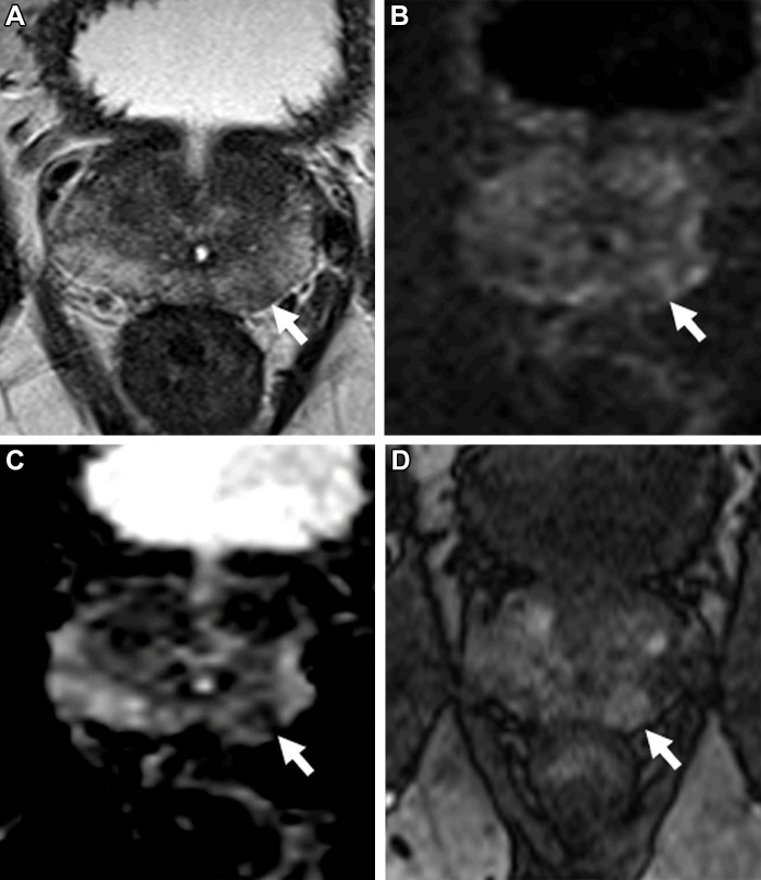 Images in a 59-year-old man with a prostate-specific antigen level of 2.9 ng/mL and a prior negative prostate biopsy. (A) Axial T2-weighted MRI scan shows a subtle, noncircumscribed, moderately hypointense focus in the left base posteromedial peripheral zone (arrow) (T2-weighted MRI Prostate Imaging Reporting and Data System [PI-RADS] score of 3). On the (B) axial diffusion-weighted image with a high b value (1400 sec/mm2), the lesion has ill-defined mildly hyperintense signal (arrow), and on the (C) apparent diffusion coefficient (ADC) map, it has markedly hypointense signal (arrow) (diffusion-weighted imaging and ADC PI-RADS score of 3). On the (D) dynamic contrast-enhanced (DCE) MRI scan, the lesion shows early contrast enhancement (arrow) (DCE MRI PI-RADS score of positive). The final assessment category assigned was PI-RADS category 4. The focal abnormality was not identified at the time of the MRI interpretation by a novice reader, who assigned PI-RADS category 2 to the examination. Upon review of the images by a more experienced reader, the lesion was identified, and an MRI-targeted biopsy of the lesion revealed prostate cancer with a Gleason score of 3+4.