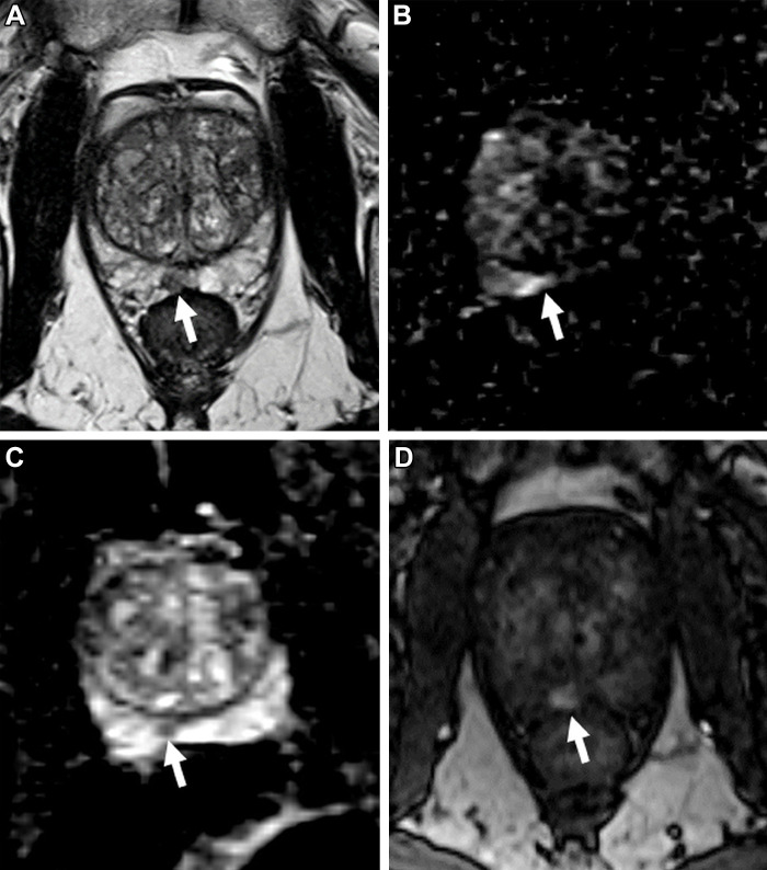 Images in a 65-year-old man with a prostate-specific antigen level of 3.4 ng/mL and no prior biopsy. (A) Axial T2-weighted MRI scan shows a 0.6-cm focal lesion with hypointense signal in the right mid posteromedial peripheral zone (arrow) (T2-weighted MRI Prostate Imaging Reporting and Data System [PI-RADS] score of 4). (B) Axial diffusion-weighted image with a high b value of 1400 sec/mm2 shows susceptibility artifacts from rectal gas (arrow), causing geometric distortion that makes it difficult to categorize the lesion. (C) The apparent diffusion coefficient map shows the lesion with a markedly hypointense signal (arrow), and it is not as distorted as at diffusion-weighted imaging. (D) Dynamic contrast-enhanced (DCE) MRI scan shows early focal contrast enhancement within this lesion (arrow) (DCE MRI PI-RADS score of positive). The DCE image helped confirm the finding on the T2-weighted image and assign a final assessment category, since at least two of the three sequences must have sufficient diagnostic quality to give a Prostate Imaging Reporting and Data System score. MRI-targeted biopsy of the lesion revealed prostate cancer with a Gleason score of 3+4.