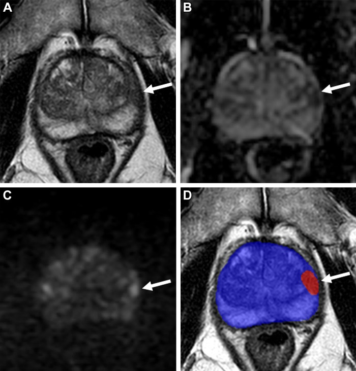 Images in a 72-year-old man with a serum prostate-specific antigen level of 8.95 ng/mL. (A) Axial T2-weighted MRI scan shows a focal hypointense lesion in the left apical–mid anterior peripheral zone (arrow). (B) Apparent diffusion coefficient map and (C) diffusion-weighted image with a b value of 1500 sec/mm2 show the lesion with mild to moderate diffusion restriction (arrows). (D) Biparametric MRI–based artificial intelligence model’s binary prediction map overlaid on the T2-weighted MRI scan automatically segments the prostate gland (blue shading) and detects the same lesion that was shown in other sequences (arrow; red shading). Transrectal US/MRI fusion–guided biopsy revealed Gleason 3+4 prostate cancer within this lesion.