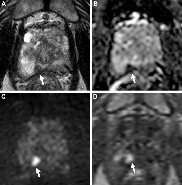 Images in a 70-year-old man with a serum prostate-specific antigen level of 6.8 ng/mL. (A) Axial T2-weighted MRI scan shows a focal hypointense lesion in the right apical peripheral zone (arrow). (B) Apparent diffusion coefficient map and (C) diffusion-weighted image with a b value of 1500 sec/mm2 show a lesion with diffusion restriction with prominent hypointense and hyperintense signal features (arrows), and (D) dynamic contrast-enhanced (DCE) MRI scan shows focal early enhancement (arrow). The T2-weighted imaging, diffusion-weighted imaging, DCE MRI, and overall Prostate Imaging Reporting and Data System (PI-RADS) scores of this lesion were 4, 4, positive, and 4, respectively. Transrectal US/MRI fusion–guided biopsy with a transperineal approach revealed Gleason 3+4 prostate cancer with cribriform pattern within this PI-RADS category 4 lesion.