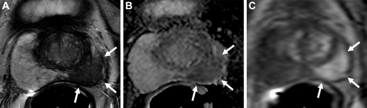 Images in a 61-year-old man with a serum prostate-specific antigen level of 8 ng/mL. (A) Axial T2-weighted MRI scan shows a large homogeneously hypointense lesion in the entire left peripheral zone (arrows). (B) The apparent diffusion coefficient map shows the lesion with mild to moderate diffusion restriction (arrows), and the (C) dynamic contrast-enhanced MRI scan shows focal early enhancement (arrows). The overall Prostate Imaging Reporting and Data System score of this lesion was 5. Transrectal US/MRI fusion–guided biopsy revealed chronic granulomatous prostatitis secondary to tuberculosis within this lesion.