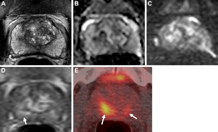 Images in a 74-year-old man with a serum prostate-specific antigen level of 12.9 ng/mL. (A) Axial T2-weighted MRI scan, (B) apparent diffusion coefficient map, and (C) diffusion-weighted image with a b value of 1500 sec/mm2 demonstrate no focal lesion within the prostate gland. (D) Dynamic contrast-enhanced MRI scan shows a very subtle linear enhancement in the right mid peripheral zone (arrow). Overall, the multiparametric MRI examination was negative for a cancer-suspicious lesion according to the Prostate Imaging Reporting and Data System. (E) Axial fluorine 18 DCFPyL PET/CT image demonstrates bilateral uptake (greater on the right side) in the prostate (arrows). Prostate biopsy revealed Gleason 4+3 prostate cancer within the right mid peripheral zone. DCFPyL = 2-(3-{1-carboxy-5-[(6-18F-fluoro-pyridine-3-carbonyl)-amino]-pentyl}-ureido)-pentanedioic acid).