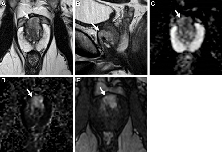 Images in a 68-year-old man with a prostate-specific antigen level of 21.8 ng/mL and a prior negative prostate biopsy. (A) Axial and (B) sagittal T2-weighted MRI scans show a lesion in the midline anterior transition zone at the mid gland, with intermediate to high signal intensity and anterior extraprostatic extension (arrows). (C) The apparent diffusion coefficient map shows diffusion restriction with moderately hypointense signal (arrow) within the lesion, while the (D) diffusion-weighted image with a high b value of 1400 sec/mm2 shows moderately hyperintense signal (arrow); the (E) dynamic contrast-enhanced MRI scan shows corresponding early arterial enhancement (arrow). The signal intensity of the lesion at T2-weighted MRI is higher than expected for typical prostate adenocarcinoma, but because of the extraprostatic extension findings, the lesion was assigned a T2-weighted MRI and an overall Prostate Imaging Reporting and Data System score of 5. MRI-targeted biopsy of the lesion revealed Gleason 4+4 prostate cancer with predominate cribriform morphology.