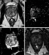 Images in a 65-year-old man with a prostate-specific antigen level of 3.4
ng/mL and no prior biopsy. (A) Axial T2-weighted MRI scan shows a 0.6-cm focal
lesion with hypointense signal in the right mid posteromedial peripheral zone
(arrow) (T2-weighted MRI Prostate Imaging Reporting and Data System [PI-RADS]
score of 4). (B) Axial diffusion-weighted image with a high b value of 1400
sec/mm2 shows susceptibility artifacts from rectal gas (arrow), causing
geometric distortion that makes it difficult to categorize the lesion. (C) The
apparent diffusion coefficient map shows the lesion with a markedly hypointense
signal (arrow), and it is not as distorted as at diffusion-weighted imaging. (D)
Dynamic contrast-enhanced (DCE) MRI scan shows early focal contrast enhancement
within this lesion (arrow) (DCE MRI PI-RADS score of positive). The DCE image
helped confirm the finding on the T2-weighted image and assign a final
assessment category, since at least two of the three sequences must have
sufficient diagnostic quality to give a Prostate Imaging Reporting and Data
System score. MRI-targeted biopsy of the lesion revealed prostate cancer with a
Gleason score of 3+4.