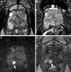 Images in a 70-year-old man with a serum prostate-specific antigen level
of 6.8 ng/mL. (A) Axial T2-weighted MRI scan shows a focal hypointense lesion in
the right apical peripheral zone (arrow). (B) Apparent diffusion coefficient map
and (C) diffusion-weighted image with a b value of 1500 sec/mm2 show a lesion
with diffusion restriction with prominent hypointense and hyperintense signal
features (arrows), and (D) dynamic contrast-enhanced (DCE) MRI scan shows focal
early enhancement (arrow). The T2-weighted imaging, diffusion-weighted imaging,
DCE MRI, and overall Prostate Imaging Reporting and Data System (PI-RADS) scores
of this lesion were 4, 4, positive, and 4, respectively. Transrectal US/MRI
fusion–guided biopsy with a transperineal approach revealed Gleason 3+4
prostate cancer with cribriform pattern within this PI-RADS category 4
lesion.