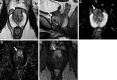 Images in a 68-year-old man with a prostate-specific antigen level of 21.8
ng/mL and a prior negative prostate biopsy. (A) Axial and (B) sagittal
T2-weighted MRI scans show a lesion in the midline anterior transition zone at
the mid gland, with intermediate to high signal intensity and anterior
extraprostatic extension (arrows). (C) The apparent diffusion coefficient map
shows diffusion restriction with moderately hypointense signal (arrow) within
the lesion, while the (D) diffusion-weighted image with a high b value of 1400
sec/mm2 shows moderately hyperintense signal (arrow); the (E) dynamic
contrast-enhanced MRI scan shows corresponding early arterial enhancement
(arrow). The signal intensity of the lesion at T2-weighted MRI is higher than
expected for typical prostate adenocarcinoma, but because of the extraprostatic
extension findings, the lesion was assigned a T2-weighted MRI and an overall
Prostate Imaging Reporting and Data System score of 5. MRI-targeted biopsy of
the lesion revealed Gleason 4+4 prostate cancer with predominate cribriform
morphology.