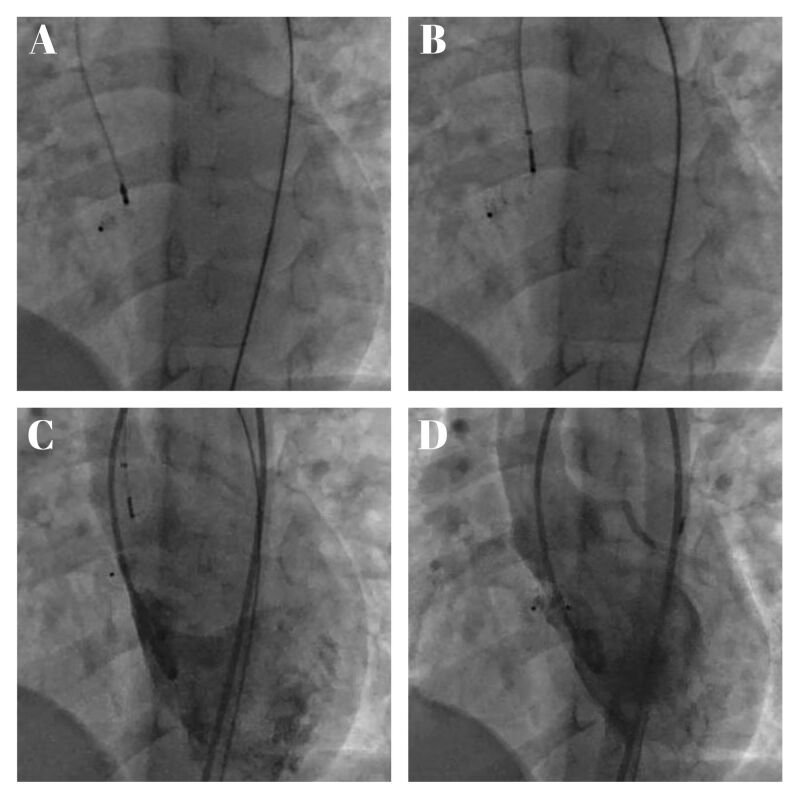 Figure 2. Largage de la prothèse Amplatzer Duct Occluder II®, incidence oblique antérieure gauche crâniale. 