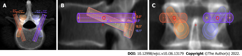 Cortical Bone Trajectory Screws In The Treatment Of Lumbar Degenerative 