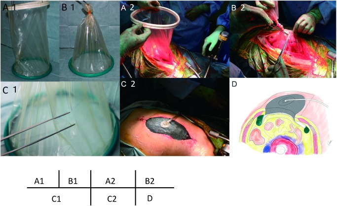 Fig. 1 Schematic of VAC system. (A1) Alexis wound protector, (B1) The ventral end of the Alexis wound protector is removed and tied. (C1) Small holes are made in the film of the wound protector to facilitate drainage and avoid sucking of the VAC system. Intestinal injuries may also be avoided by the filtering effect of this film. (A2) The Alexis wound protector is placed permanently into the peritoneal cavity to expose the abdominal cavity. (B2) The outer ring is removed from the plastic cylinder, which is then ligated. (C1) Small holes are cut in the plastic cylinder. The skin is partially closed and fitted to the protector. (C2) The VAC system is applied to the sponge to aspirate the peritoneal fluid and exudate under a continuous negative pressure of –50 mmHg. (D) A cross-sectional schematic diagram of a patient’s abdomen. VAC: vacuum assisted closure