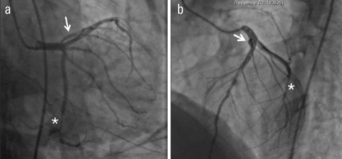 First diagonal artery arising from the left main coronary artery: A ...