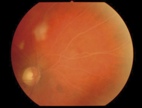 Lipemia retinalis – an unusual cause of visual acuity deterioration - PMC