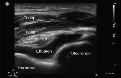 Point-of-Care Ultrasound-Directed Evaluation of Elbow Effusion - PMC