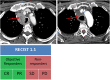 Objective response rate reflects the degree of tumor shrinkage and is defined as the proportion of patients who experience a complete response (CR) or partial response (PR) while receiving treatment. A, A patient who underwent chest CT that revealed a single site of disease at baseline experienced, B, marked decreased size of the right paratracheal lesion, and thus is an objective responder. C, Objective responders are the percentage of patients with CR and PR. Arrow indicates the single site of disease, mediastinal lymphadenopathy. PD = progressive disease, RECIST 1.1 = Response Evaluation Criteria in Solid Tumors version 1.1, SD = stable disease.