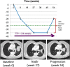 Time to progression (TTP) is the total time from which the patient starts treatment until radiologic disease progression. In this example, the patient’s tumor grew 20% from nadir, reaching disease progression. TTP was 54 weeks. SOD = sum of diameters.