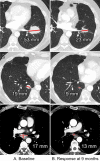 Baseline and follow-up CT images in a 55-year-old man with metastatic melanoma. CT imaging of the chest, abdomen, and pelvis was from A (left column), clinical trial enrollment and, B (right column), evaluation for treatment response at 9 months. At each time, the following were assessed: left lower lobe mass (row 1, top), right lower lobe nodule (row 2, middle), and subcarinal lymph node (row 3, bottom). The sum of diameters at baseline was 89 mm and at follow-up was 45 mm (a decrease of 49%), which was categorized as partial response. Dotted line represents the measured longest diameter of a lymph node. Solid line represents short-axis measurement.