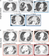 Representative chest CT images of the categories of French Society of
Radiology–Society of Thoracic Imaging scores. (A) Diagnostic scores
are as follows: 1, normal; 2, non–SARS-CoV-2 infection (bacterial
bronchopneumonia [arrowhead]); 3, indeterminate (single ground-glass
opacities [white arrowhead] and contralateral subpleural consolidation
[black arrowhead]); 4, compatible with COVID-19 (bifocal ground-glass
opacities and consolidation [arrowheads]); and 5, typical for COVID-19. (B)
Severity score, depending on the volume of lung parenchyma affected by
COVID-19 (arrowheads indicate subtle focal ground-glass opacities). The
color scheme used for both scores is used in Figures S1–S3. All
images correspond to axial CT pulmonary angiographic images with lung
kernel.