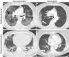 Representative examples of patients with different vaccine statuses
during the Delta- and Omicron-predominant periods. (A) Axial CT pulmonary
angiographic scan (with lung kernel settings) in a 65-year-old unvaccinated
male patient during the Delta-predominant period shows CT findings typical
of COVID-19 (ie, bilateral and asymmetric ground-glass opacities [white
arrows] affecting the central and peripheral lung, associated with
reticulations [black arrow] responsible for the crazy-paving pattern). The
severity score assessed based on results of the entire CT pulmonary
angiographic examination was severe extent. (B) Axial CT pulmonary
angiographic scan in a 57-year-old vaccinated male patient (two doses)
during the Delta-predominant period shows chest CT findings compatible with
COVID-19 (ie, single unilateral peripheral ground-glass opacities [arrow])
with a minimal severity score. (C) Axial chest CT scan obtained without
contrast medium in a 69-year-old unvaccinated male patient during the
Omicron-predominant period shows peripheral, bilateral, and asymmetric
consolidations (arrowheads), classified as compatible with COVID-19. The
severity score for the entire chest CT examination was extended. (D) Axial
CT pulmonary angiographic scan in a 70-year-old vaccinated female patient
(three doses) shows a single small peripheral lesion combining ground-glass
opacities and consolidation (arrow) classified as indeterminate, with a
minimal severity score.