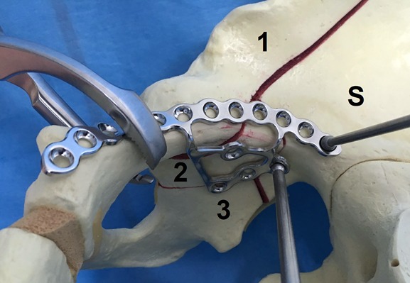 Open Reduction and Internal Fixation of Acetabular Fractures Using the ...