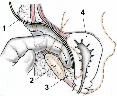 Fig. 3-D